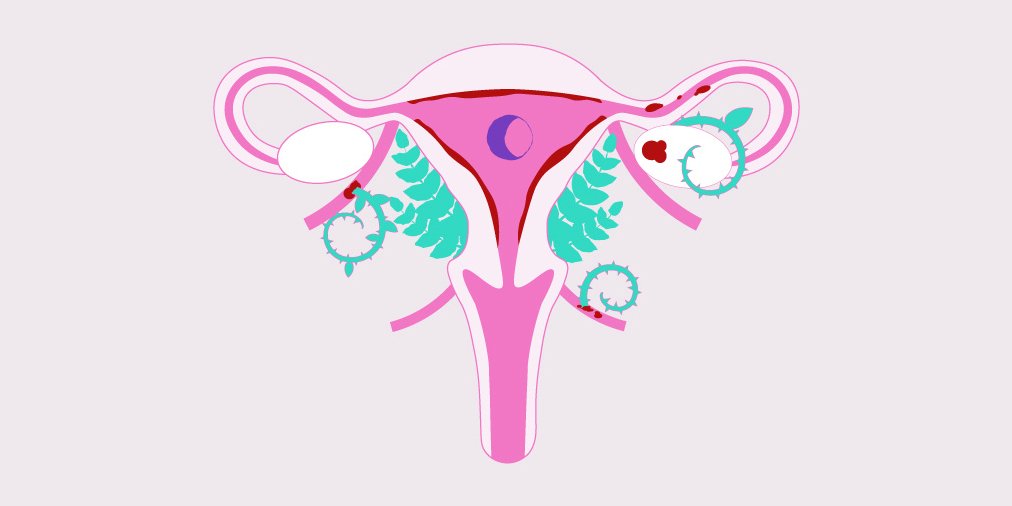 Endometriosis 101: Do you have endometriosis symptoms?